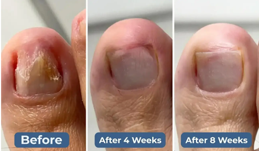 Welnax BioClear Laser Nail Care Before after